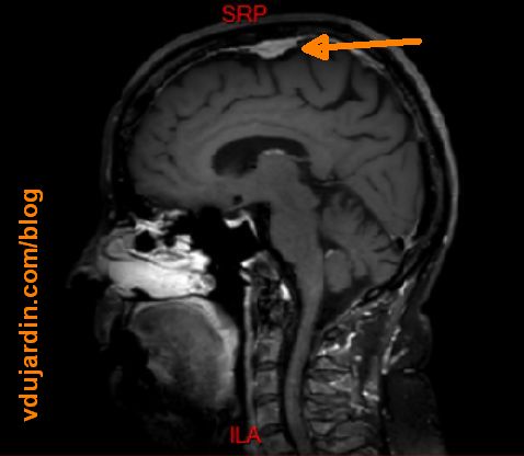 Mon troisième méningiome, en haut du crâne, est indiqué par une flèche